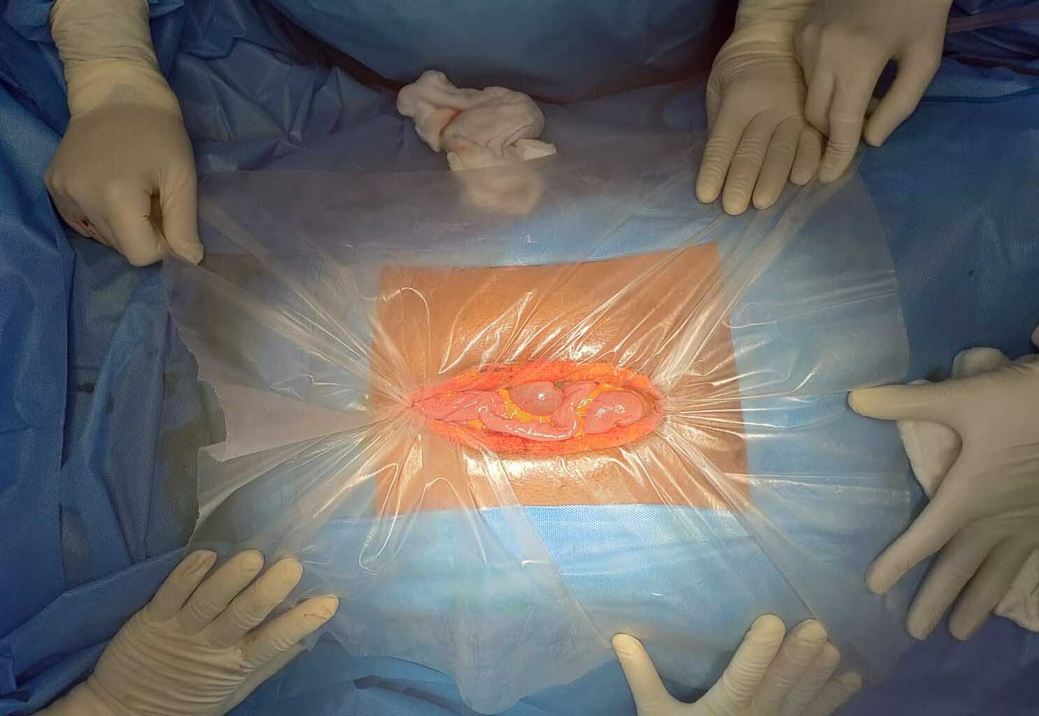 wound protector, surgical device